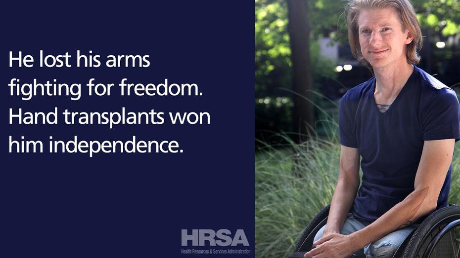 Perdió sus brazos luchando por la libertad. Los trasplantes de manos le dieron independencia.